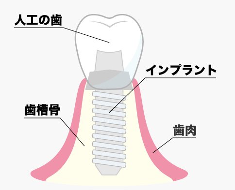 インプラント